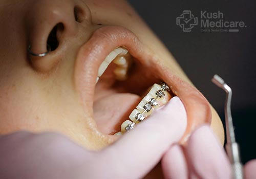 Braces & Aligners at KushMedicare Noida