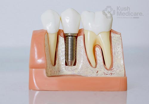 RCT, Crowns & Bridges at KushMedicare Noida